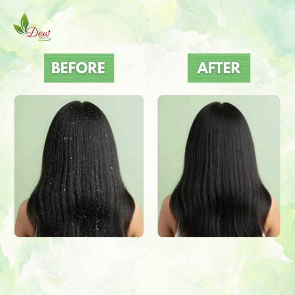 Anti Dandruff Oil